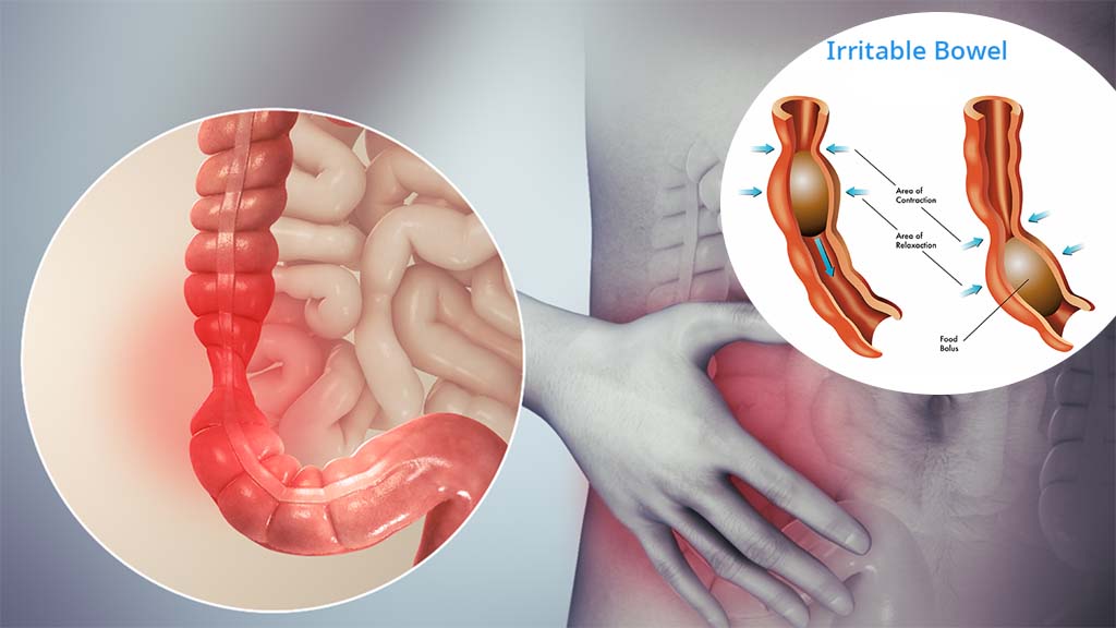 Pan integral colon irritable