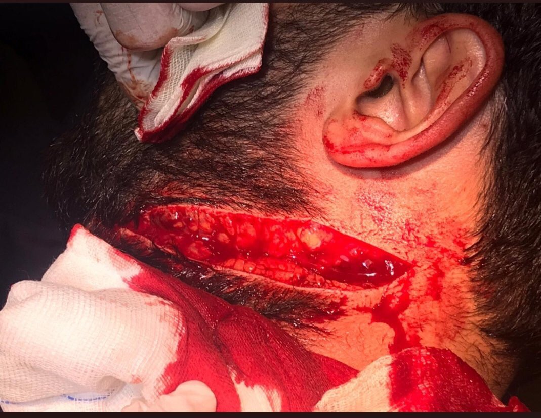 DrTulay_67's tweet photo. Korkunç ama bugünkü sağlıkta şiddetin fotoğrafı bu..Umarım hayati tehlikeyi atlatır meslektaşımız..Çok üzgünüm.. #ölürsemiyileştiremem https://t.co/e0glosQIYc