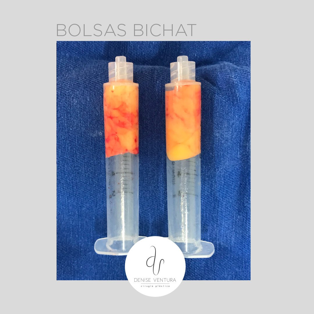 venturadenise's tweet photo. El rostro en forma de V se puede conseguir con un procedimiento rápido, seguro y sencillo: la #bichetomía. Unas pequeñas incisiones al interior de la boca se extrae la grasa bucal o bolsa de bichat, que permite adelgazar la cara definiendo el contorno facial.
Citas:+573228024411 https://t.co/lkYkzvXL7g