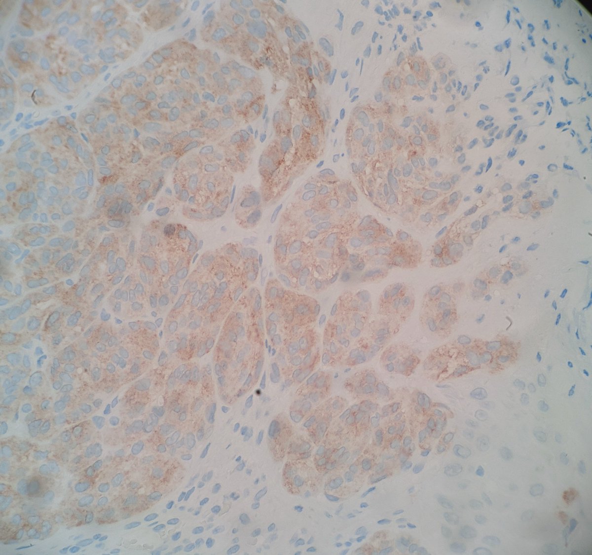 One typical feature of NTRK1 fusion Spitz lesions is a "nest of nests" pattern - what looks like a nest at low power turns out to be smaller nests rammed together at higher power. IHC is pan NTRK. #dermatology #dermpath #pathology