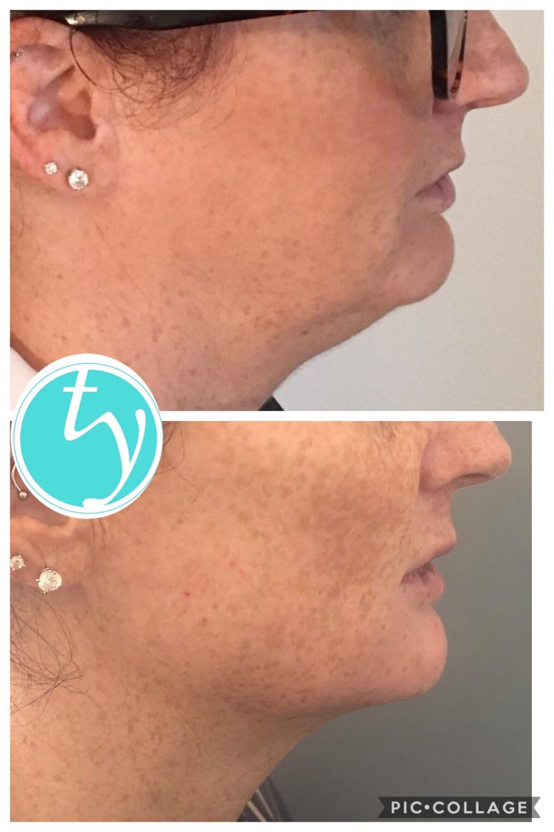 A combination of treatment. Skin tightening and dermal fillers are used here to achieve a contoured jawline . #contouredjaw #saggingjawlines #jowles #getridofjowles #hifuleeds #hifubradford #leedsskinclinic #bradfordskinclinic #AgeingBetter #dermalfillersleeds #aliaxin #ha_derma