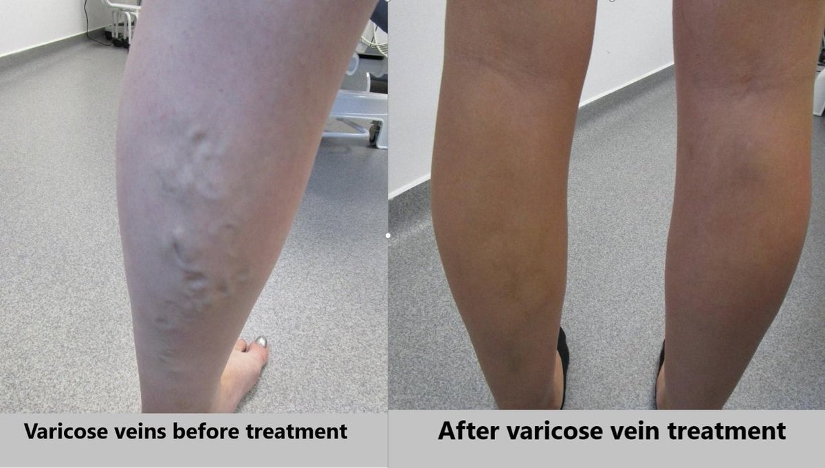 CoodenMedical's tweet photo. Had enough of hiding your varicose veins?  

Find out more about the latest treatments at our free event on Thursday, October 31 at 7pm.  Call 01424 846190 to book.

Read more about varicose vein treatments at https://t.co/pHQKVyJzAP https://t.co/nj9vw8y8JW
