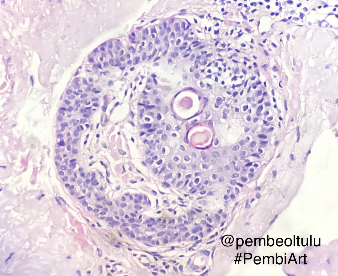 Such a nice surprise in a skin bx #PathArt #pathology

<a href="/smlungpathguy/">Sanjay Mukhopadhyay</a> <a href="/JMGardnerMD/">Jerad Gardner, MD</a> <a href="/GeronimoJrLapac/">Gerônimo Jr.</a> <a href="/MPathyart/">MPathy Art/Mary Landau</a> <a href="/IHeartHisto/">I Heart Histo</a> <a href="/AmyHDeekenMD/">🅰🅼🆈🅷🅳🅴🅴🅺🅴🅽🅼🅳</a> <a href="/rositadeolivop1/">Rosalinda Peñaloza</a> <a href="/luishcruzc/">Luis Humberto Cruz C</a> <a href="/sam_albadri/">Sam Albadri, M.D., M.Sc.</a> <a href="/PathologySayah/">Maryam Sayah, MD</a> <a href="/DrRolaAli/">Rola Ali, MD</a> <a href="/preethijaison/">Preethi Paul</a> @Halima81819652 <a href="/raghupillappa/">Raghavendra Pillappa</a> <a href="/NejibY/">Nejib Ben Yahia, MD</a> @HermelinDaniela