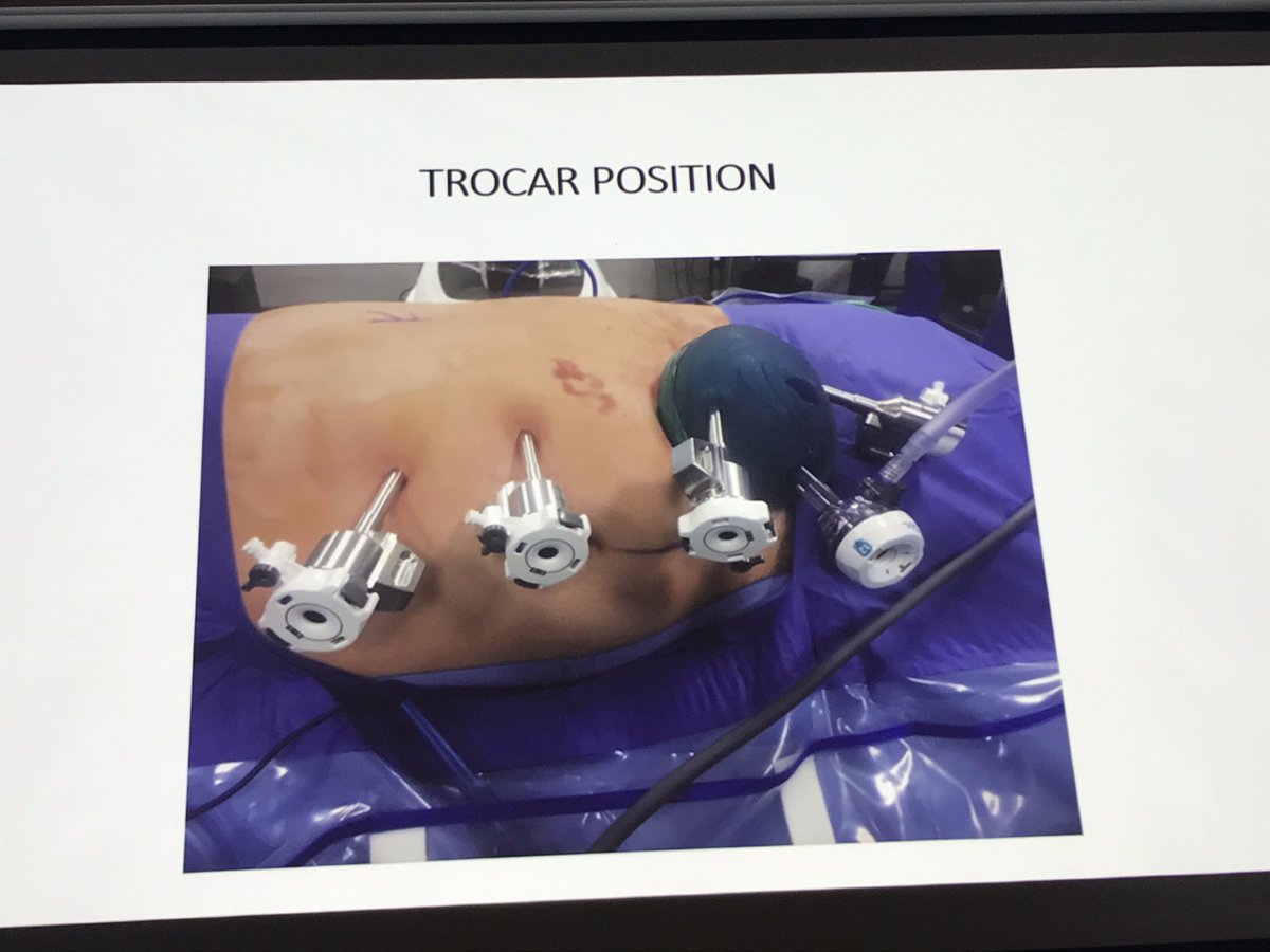 Experience in robotic assisted live donor nephrectomy <a href="/GSTTnhs/">Guy's and St Thomas'</a> by <a href="/LoukopoulosI/">Loukopoulos Ioannis</a> 10 cases performed so far.