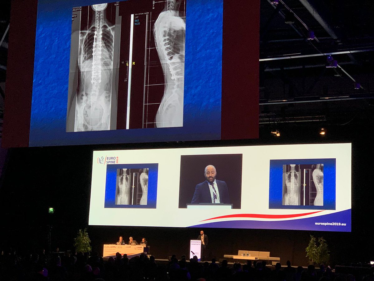 Presenting the safety profile of the Ultrasonic Bone Scalpel in spinal surgery <a href="/EUROSPINESoc/">EUROSPINE</a> 2019 Helsinki.  #eurospine2019 #spine #scoliosis #complexspine