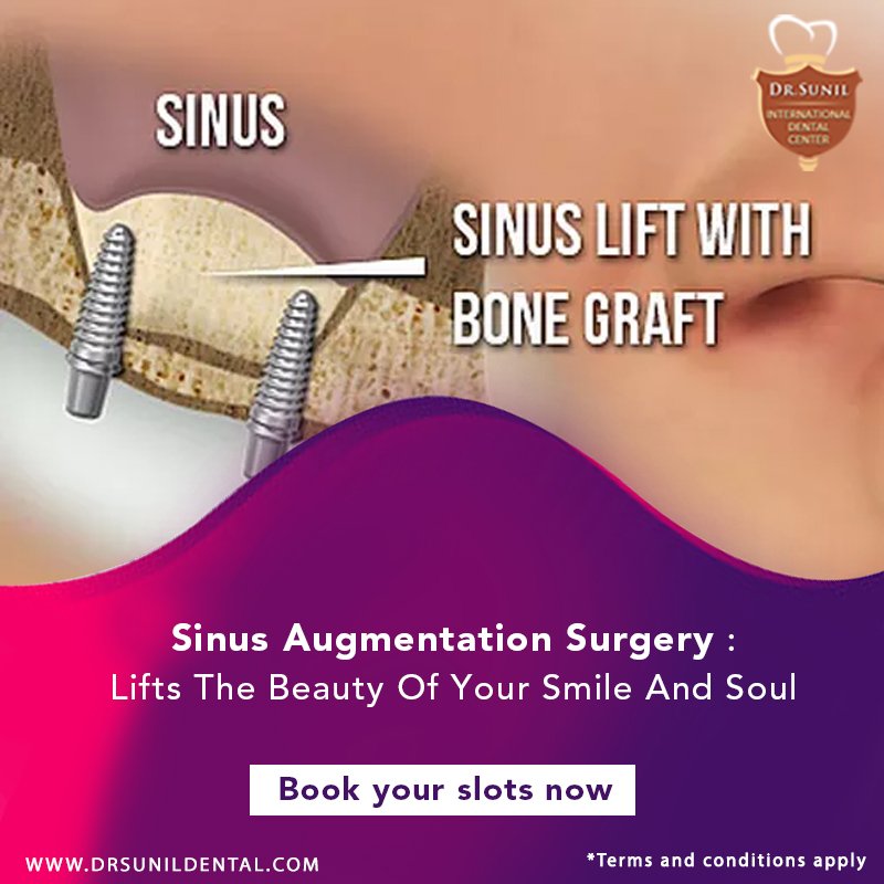 drsunilphol's tweet image. #Sinus #SinusProblem #SinusLift #BoneGraft #Dentistry #DentalTreatment #BangkokDiscoverYourSmile #Dental #DrSunilDentalClinic #BangkokDentist 
Visit: drsunildental.com

Call us on: + (66)-81648-5780 or + (66)-2314-6238
WhatsApp No: +66816485780
Email: info@drsunildental.com