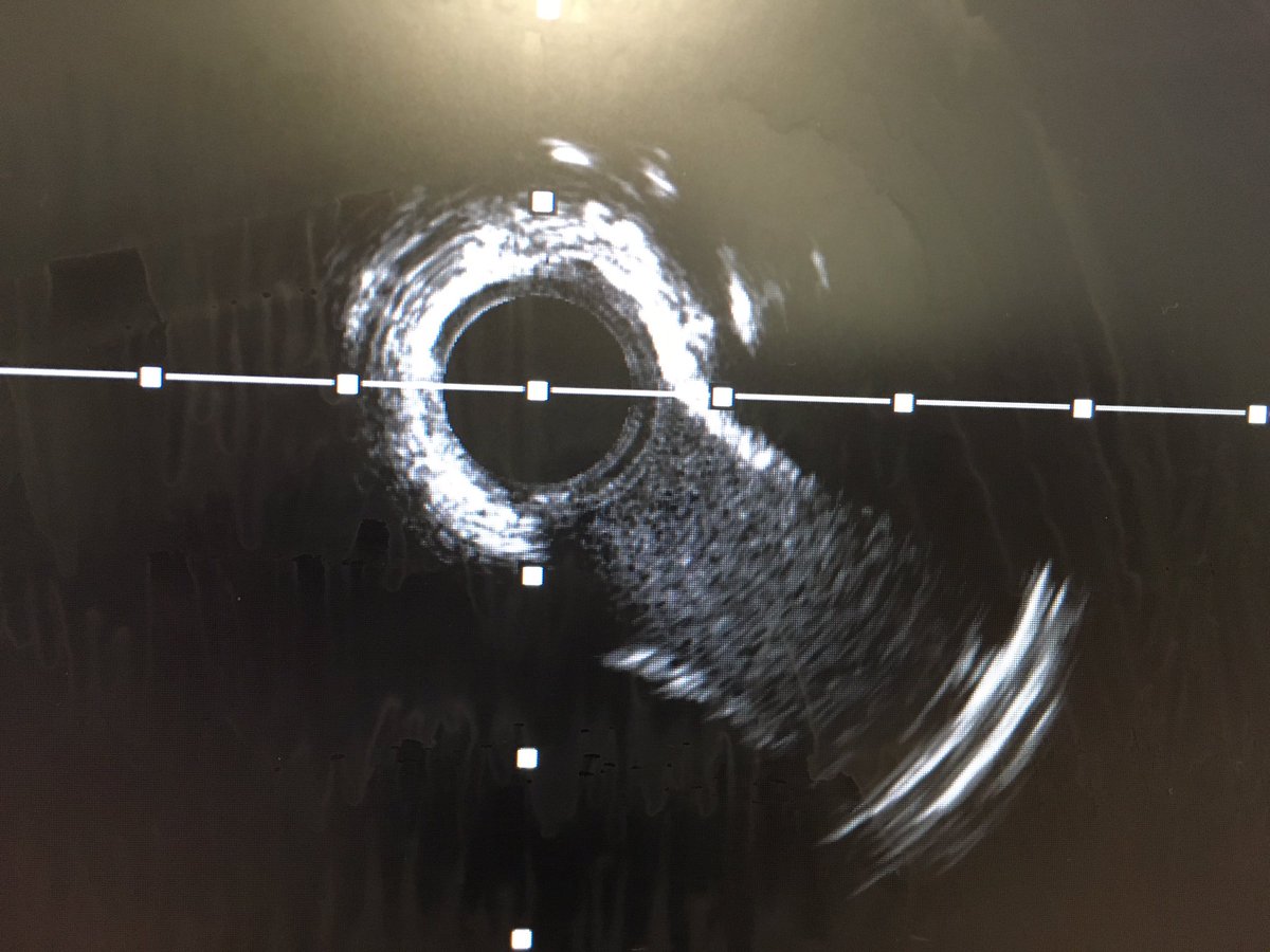 colum_owens's tweet photo. @aimradial thanks for the invite for the course! Looks can be deceiving. Imaging and calcium modification essential for calcified lesions. Note fracture lines with shockwave balloon for 270 arc. MLA 3 to 7.8 with onyx stent @ShockwaveIVL @Medtronic @DrBArmstrongPhD @BelfastTrust https://t.co/ZSCLS0PnxY