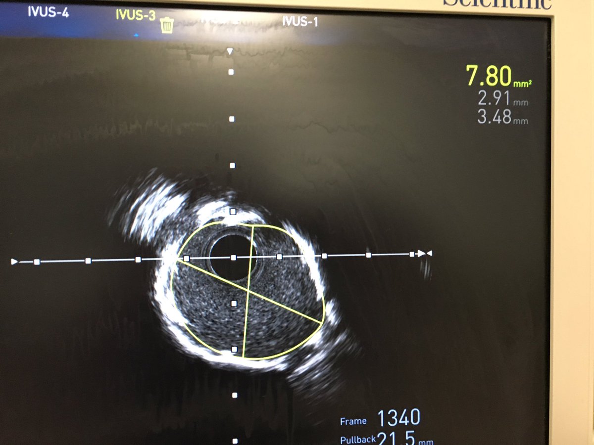 colum_owens's tweet photo. @aimradial thanks for the invite for the course! Looks can be deceiving. Imaging and calcium modification essential for calcified lesions. Note fracture lines with shockwave balloon for 270 arc. MLA 3 to 7.8 with onyx stent @ShockwaveIVL @Medtronic @DrBArmstrongPhD @BelfastTrust https://t.co/ZSCLS0PnxY