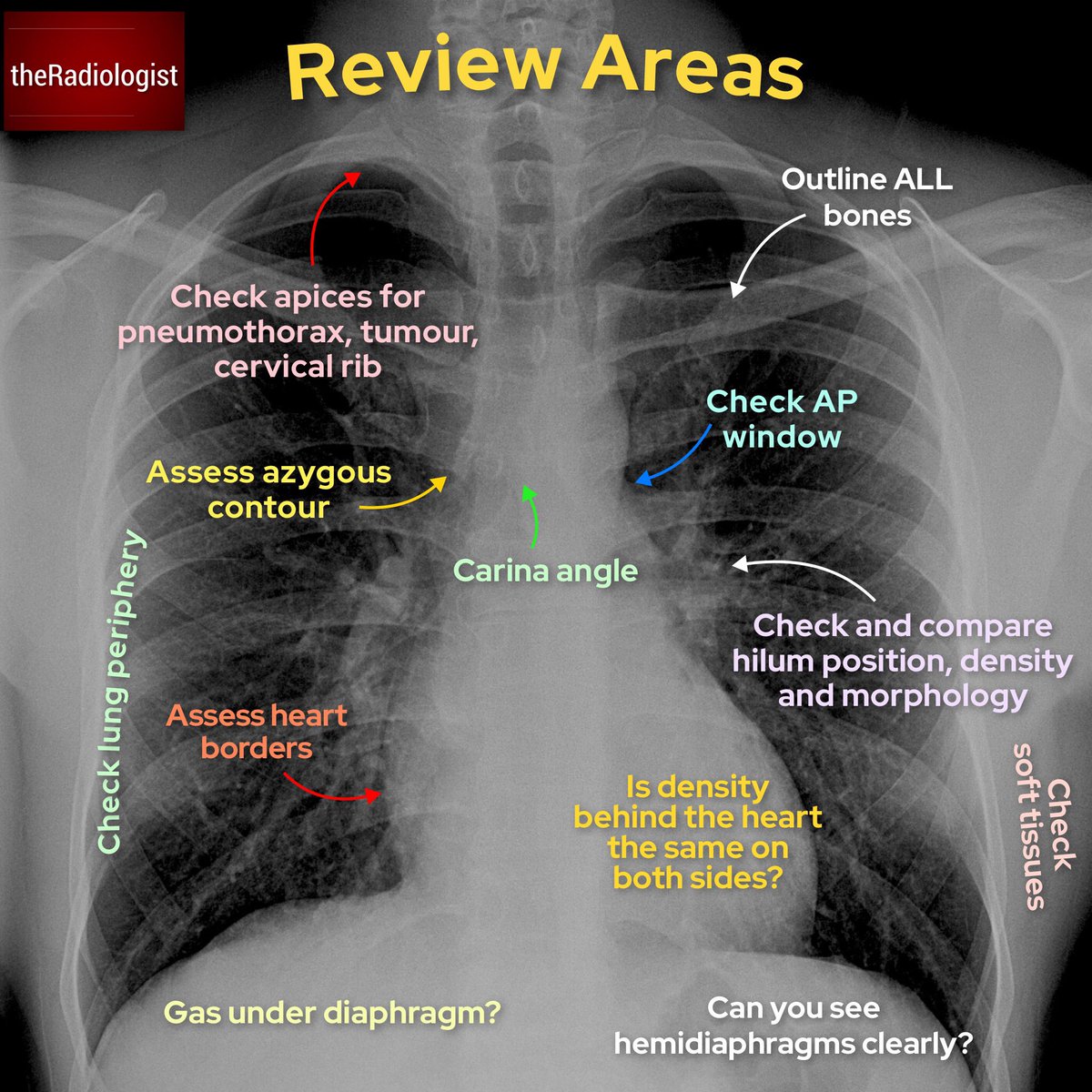 Anatomy Of Chest X Ray Computer Aided Detection In Chest Radiography ...