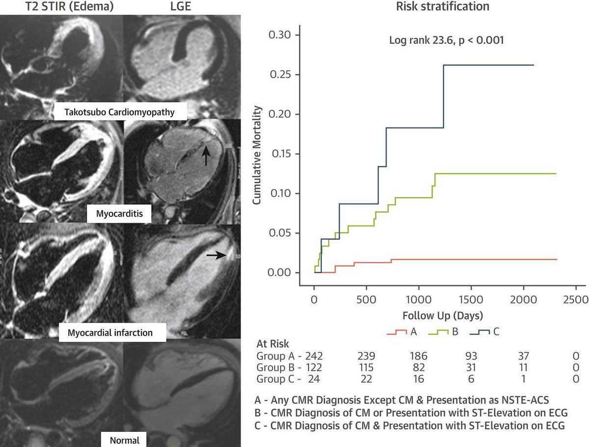 JACC Journals (@jaccjournals) on Twitter photo Making sense of #MINOCA through #CMR? In this study, CMR identified the cause in 74% of patients (myocarditis, #cvMI and cardiomyopathy). Mortality was predicted by CMR diagnosis of cardiomyopathy and ECG ST elevations. fal.cn/34z25 #JACCIMG <a href="/DeepDastidar/">Amardeep Dastidar</a> <a href="/ChiaraBD/">C Bucciarelli-Ducci</a> Making sense of #MINOCA through #CMR? In this study, CMR identified the cause in 74% of patients (myocarditis, #cvMI and cardiomyopathy). Mortality was predicted by CMR diagnosis of cardiomyopathy and ECG ST elevations. fal.cn/34z25 #JACCIMG <a href="/DeepDastidar/">Amardeep Dastidar</a> <a href="/ChiaraBD/">C Bucciarelli-Ducci</a>