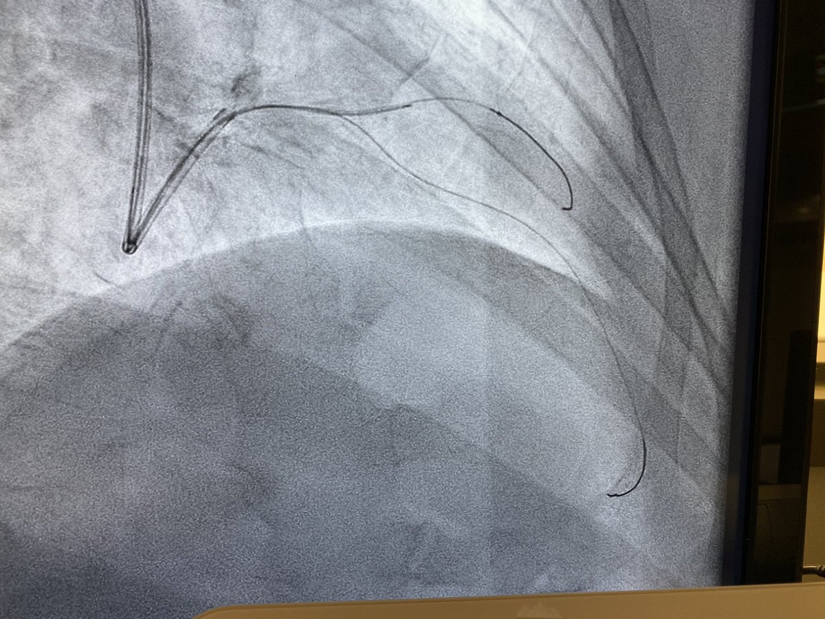 ElliottMGroves's tweet photo. Many thanks to organizers of @aimradial for inviting us as live case site. Great case yesterday, staged LAD/D1 bifurcation in pt w/stage IV/V CKD. IVUS guided, 7cc con for final shot. @csi360 prep due to 360 Ca2+ arc at bifurcation. Wonderful panel, @ARS_MD2004 scrubbed in w/me. https://t.co/suoRAMEsvR
