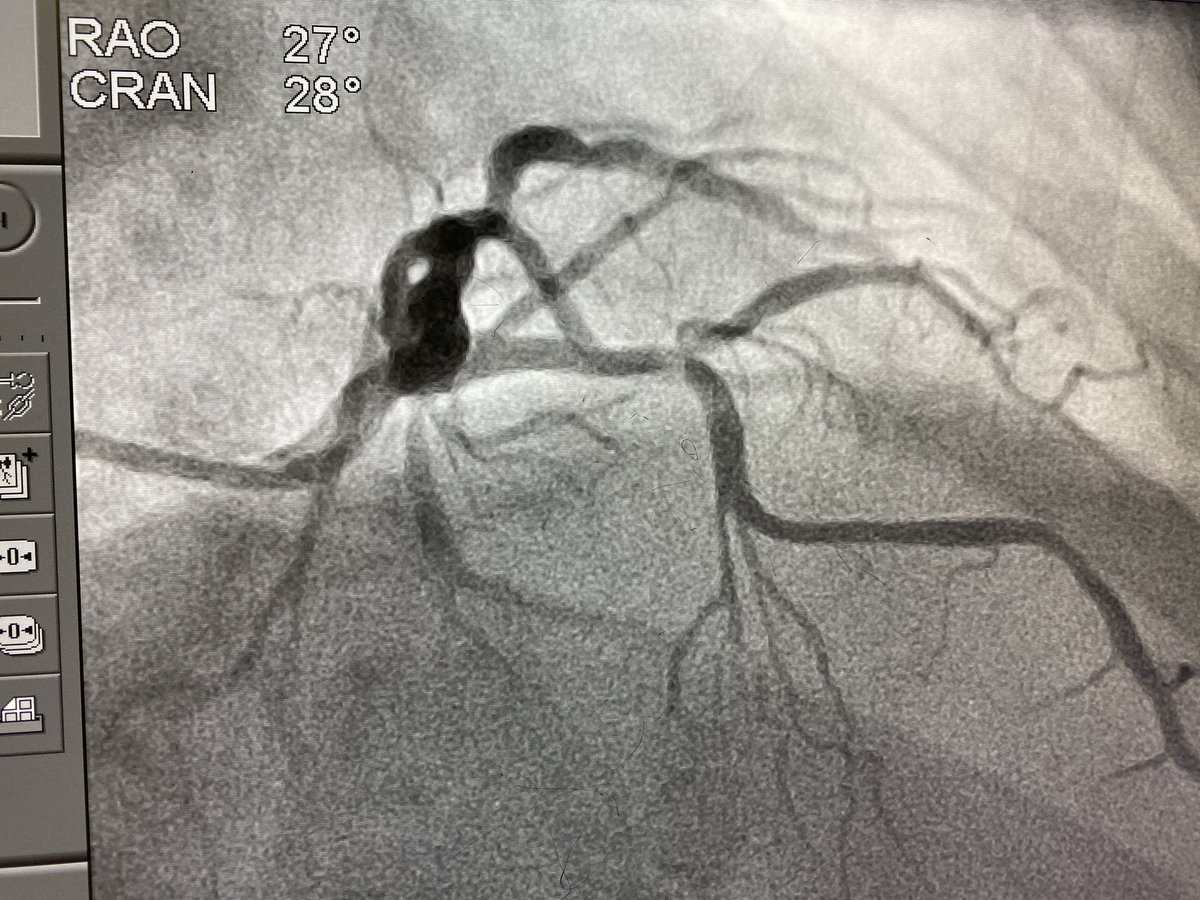 ElliottMGroves's tweet photo. Many thanks to organizers of @aimradial for inviting us as live case site. Great case yesterday, staged LAD/D1 bifurcation in pt w/stage IV/V CKD. IVUS guided, 7cc con for final shot. @csi360 prep due to 360 Ca2+ arc at bifurcation. Wonderful panel, @ARS_MD2004 scrubbed in w/me. https://t.co/suoRAMEsvR