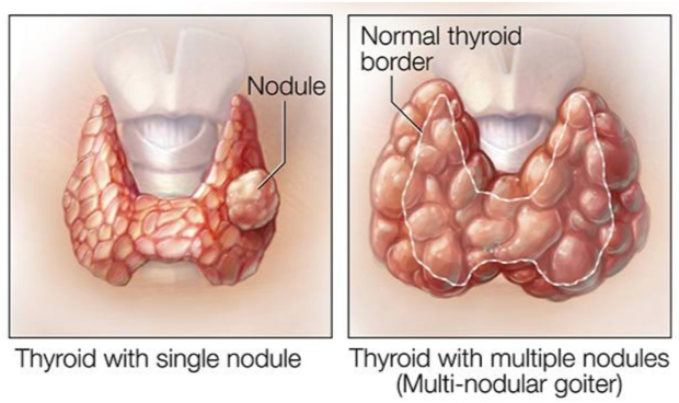 UCLAHealth's tweet photo. What are thyroid nodules? They are often oval-shaped lumps that form in your thyroid gland. "Hot" nodules may overproduce thyroid hormones. #Thyroid nodules are relatively common and rarely cancerous.➡️https://t.co/0z9RQXE188
#UCLAMDChat #UCLAEndocrine https://t.co/eJBh1gzvEf