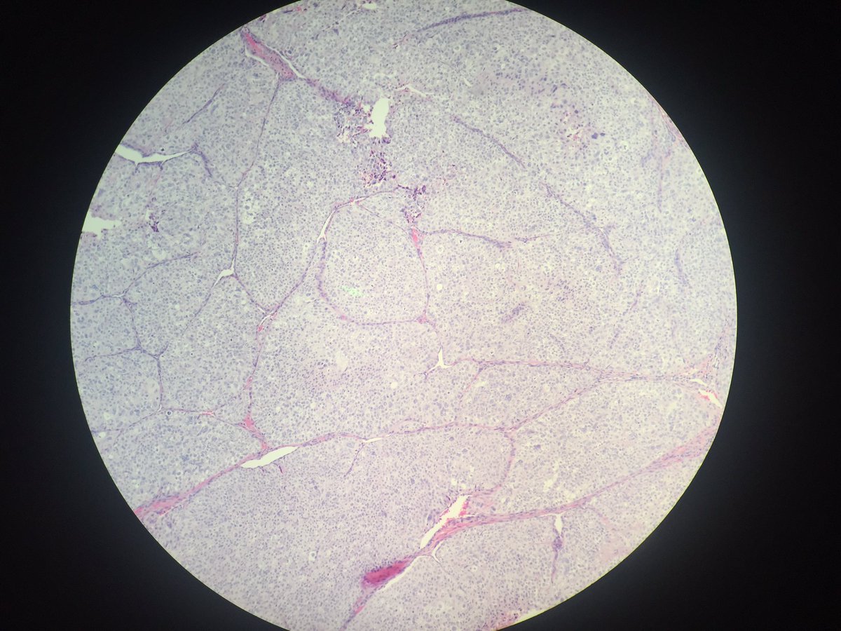 But finding my first Insular Thyroid Carcinoma today made me feel better #pathology #microscopy