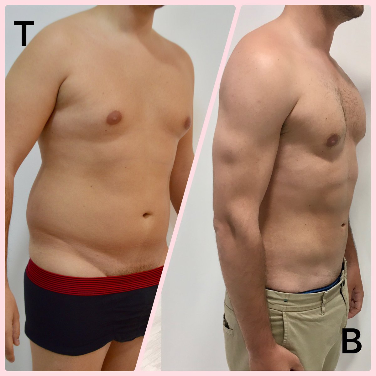 Coolsculpting before and after Pic in NYC