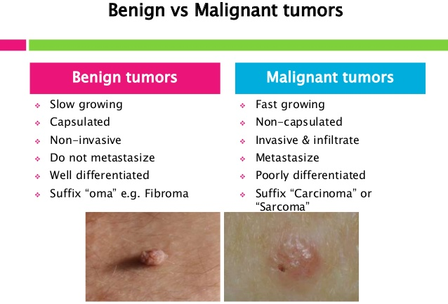 cancer malign vs benign)