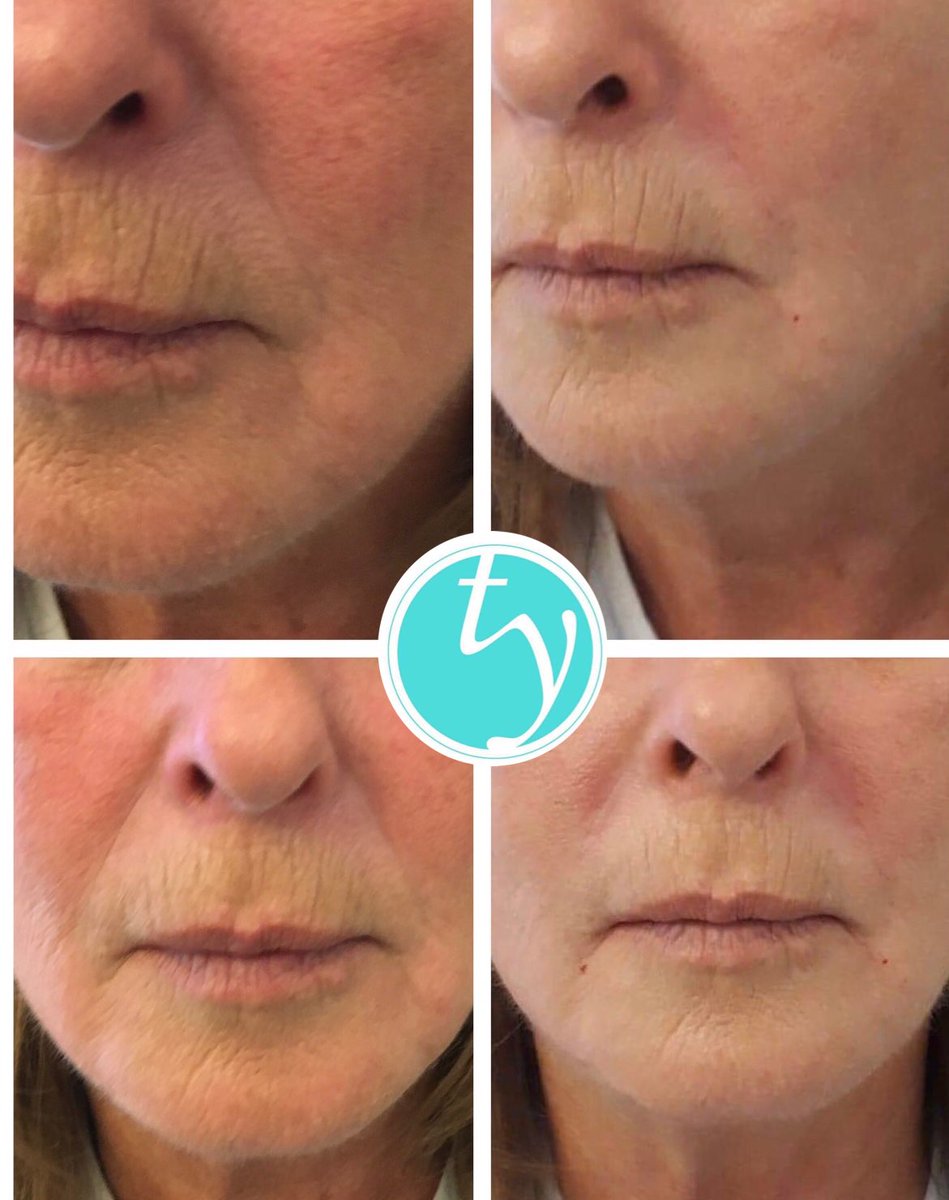 Softening to nose to mouth lines ! You don’t have to@look@like you’ve been overfilled