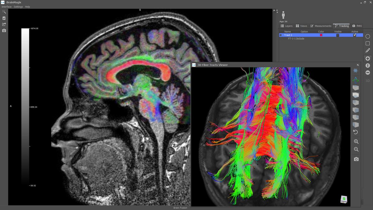 Imagilys's tweet photo. The corpus callosum (red) connects the two hemispheres of the brain. It is divided into four parts: the rostrum, the genu, the body, and the splenium, each responsible for connecting distinct areas of the cortex. The images were processed in #BrainMagix. https://t.co/8DgWFnd4gY