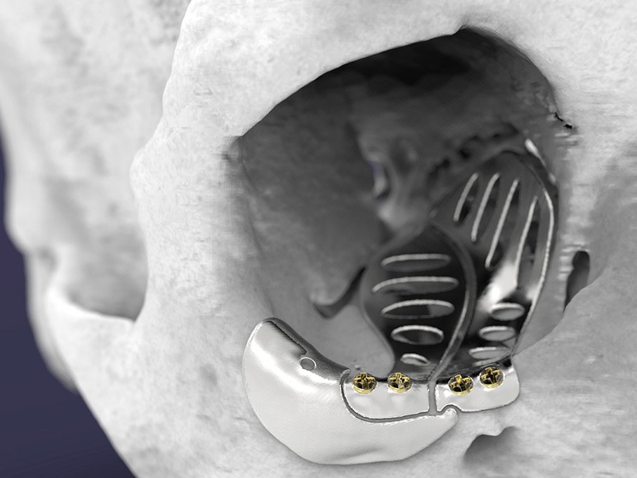 If you're in the business of #PatientSpecificImplants #FacialProsthetics #MedicalInstruments #MedicalDevices #Maxillofacial #Craniofacial #Surgery #SurgicalRobotics #VirtualRealityTraining, get involved with the ADT Foundation. adt-foundation.com/IndustryPartne…