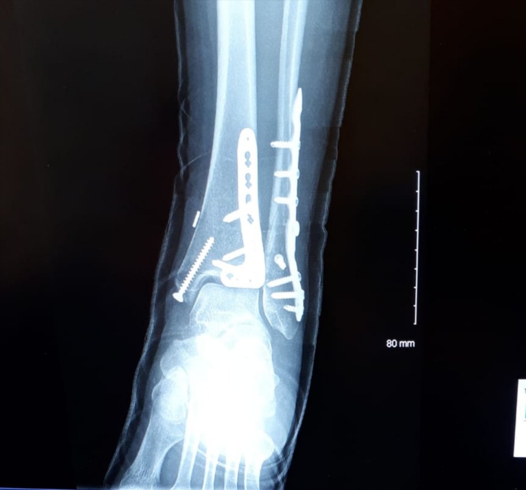 JaniceKearns's tweet image. Feeling bit nervous today. Having surgery to remove these plates and screws. Pray for me. 😬🙈 #hardwareremoval