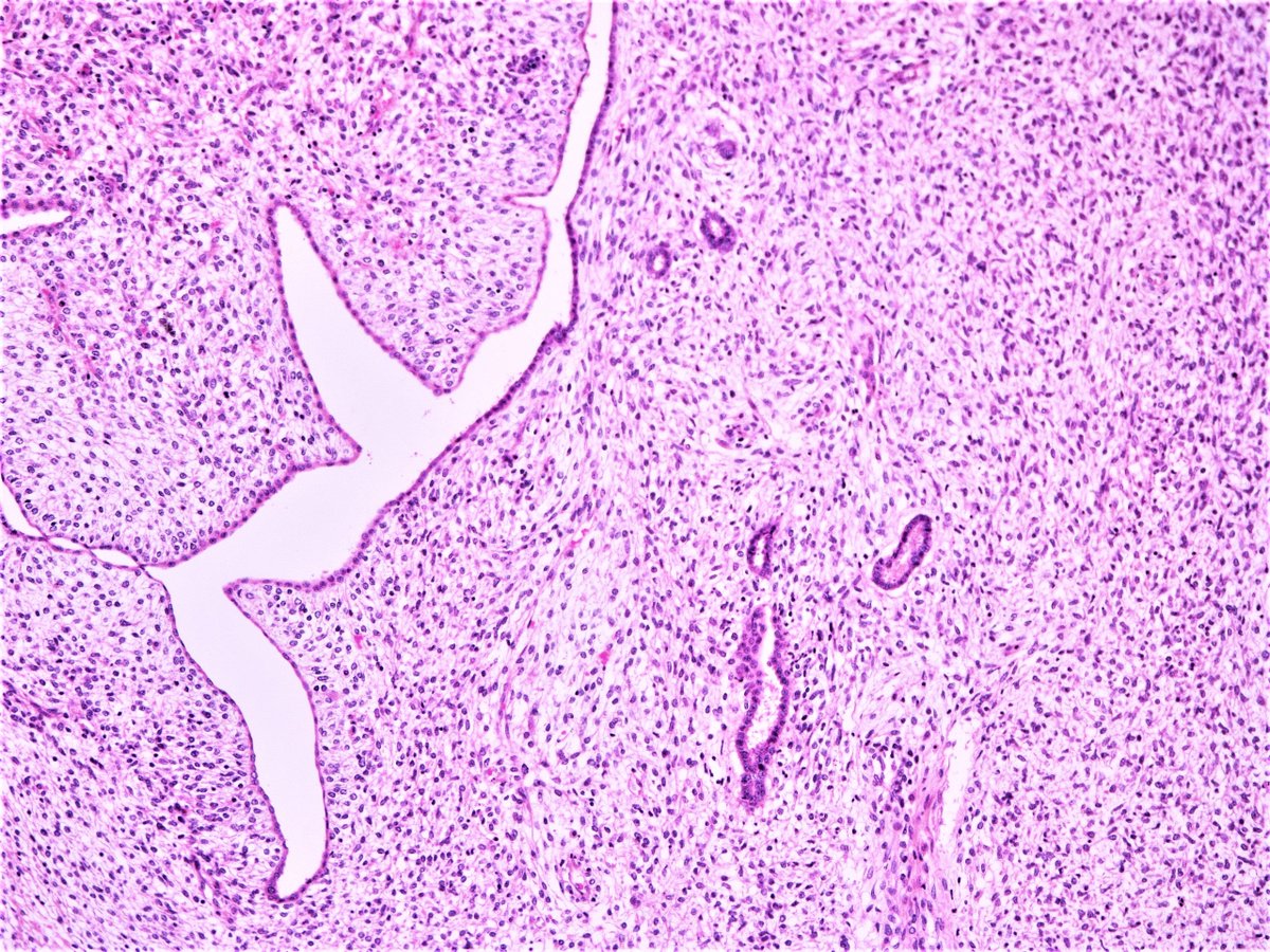 Patholwalker's tweet image. Nephroblastoma. Kidney, nephrectomy#pathologist #pathology #Pedipath