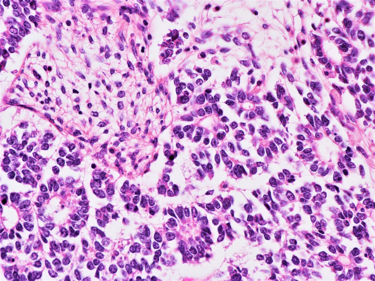 Nephroblastoma. Kidney, nephrectomy#pathologist #pathology #Pedipath