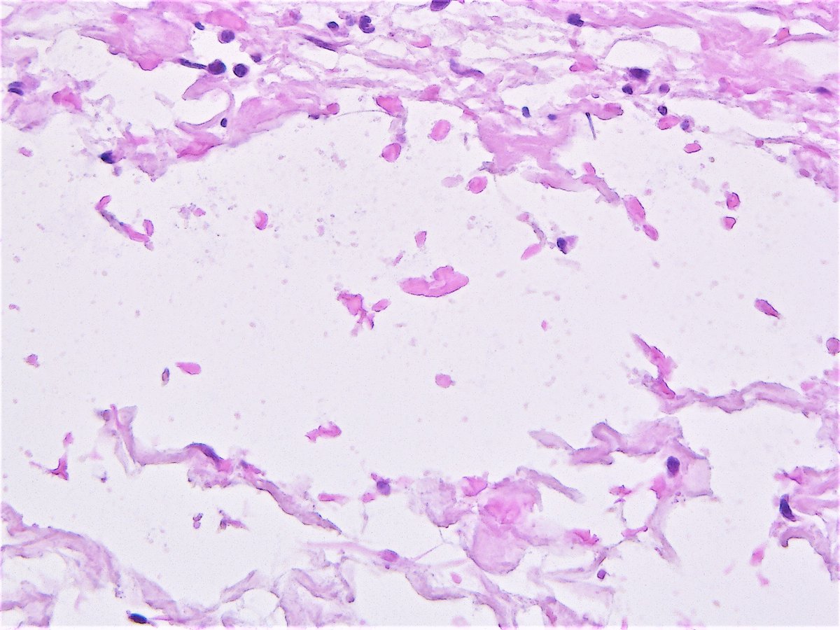 Patholwalker's tweet photo. Digital mucous cyst. HE and gross. #pathologist #pathology #skinpathology #dermpath https://t.co/nWWnBsBMpa