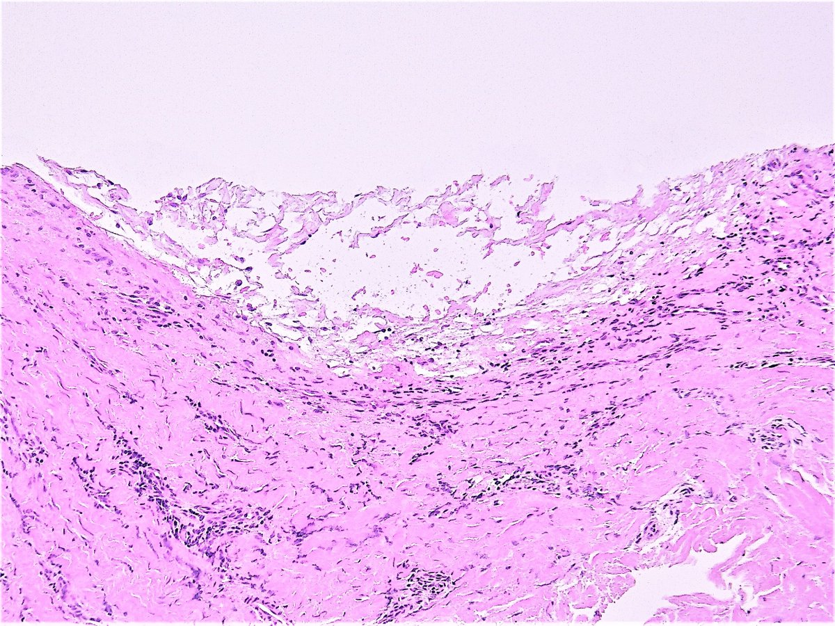 Patholwalker's tweet photo. Digital mucous cyst. HE and gross. #pathologist #pathology #skinpathology #dermpath https://t.co/nWWnBsBMpa