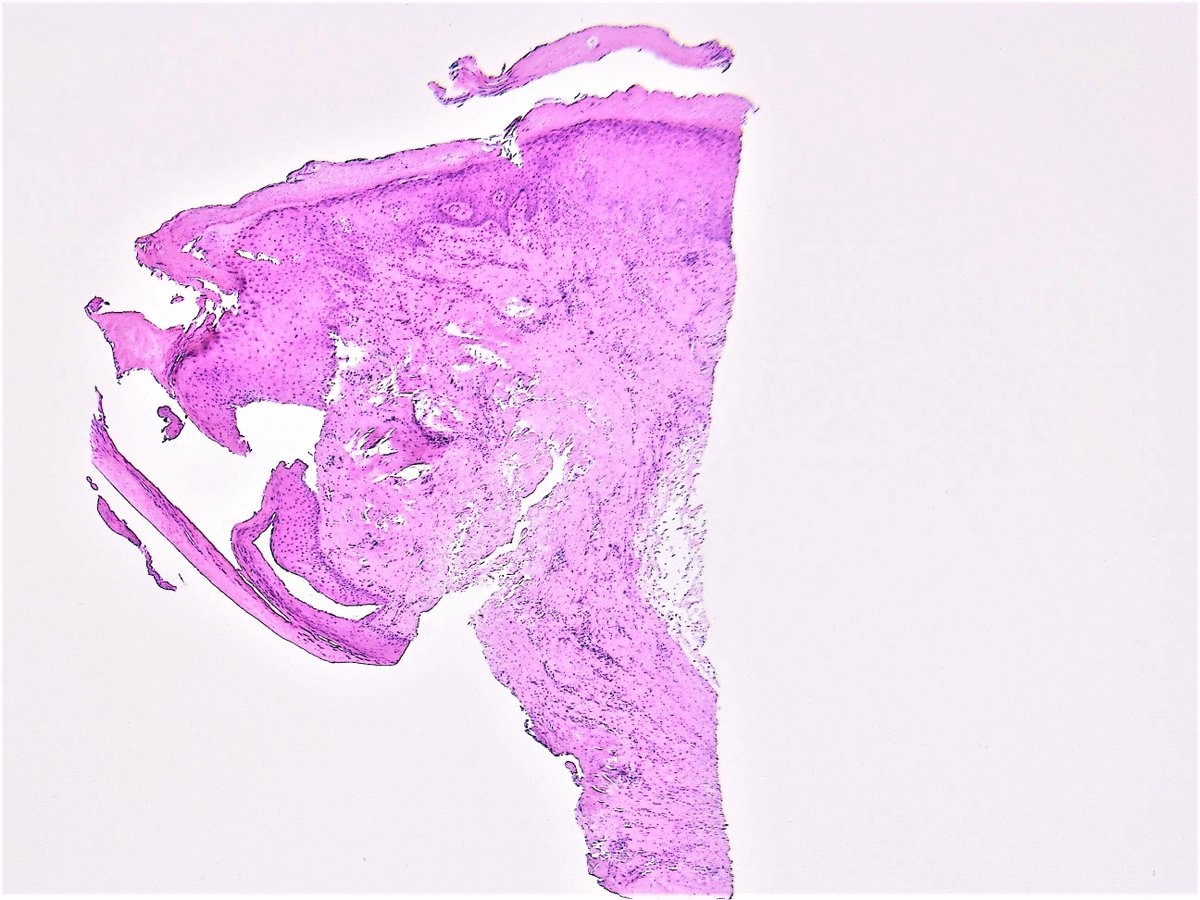 Patholwalker's tweet photo. Digital mucous cyst. HE and gross. #pathologist #pathology #skinpathology #dermpath https://t.co/nWWnBsBMpa