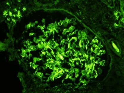 Patholwalker's tweet image. IgA nephropathy. HE, PAS, PAM and DIF(IgA). #pathology #pathology #nephropath