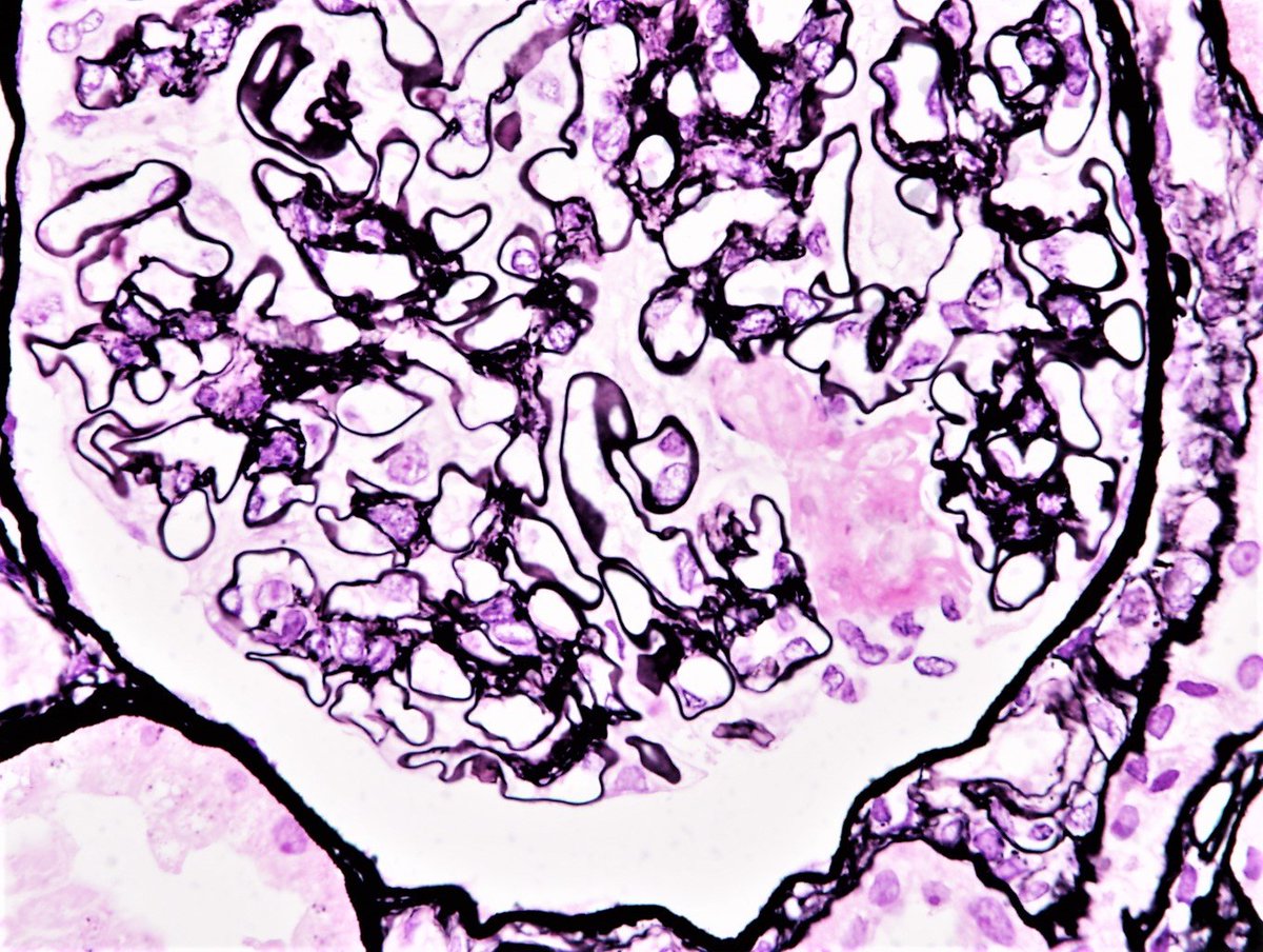 Patholwalker's tweet image. IgA nephropathy. HE, PAS, PAM and DIF(IgA). #pathology #pathology #nephropath