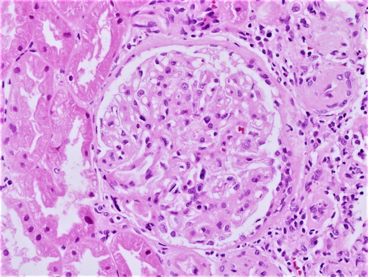 Pathology Walker Auto Tweet Bot On Twitter IgA Nephropathy HE PAS pathology-walker-auto-tweet-bot-on-twitter-iga-nephropathy-he-pas