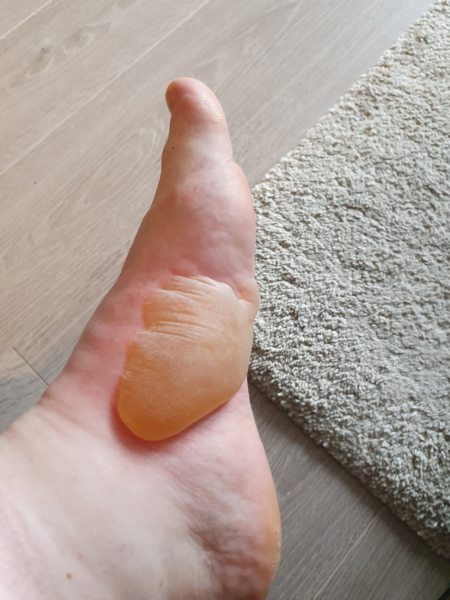 Popping poison ivy sale blisters