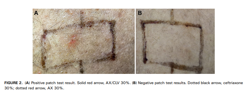 JACIInPractice's tweet photo. In Press! #Acute Generalized #Exanthematous #Pustulosis Due to #Clavulanic #Acid https://t.co/1RxywyvBRk https://t.co/fQQBEUJGXu