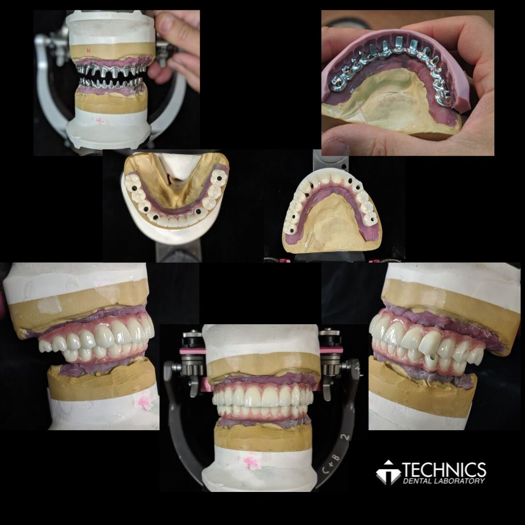 Technics Dental Lab on Twitter "Fulll Contour Zirconia Bridge over