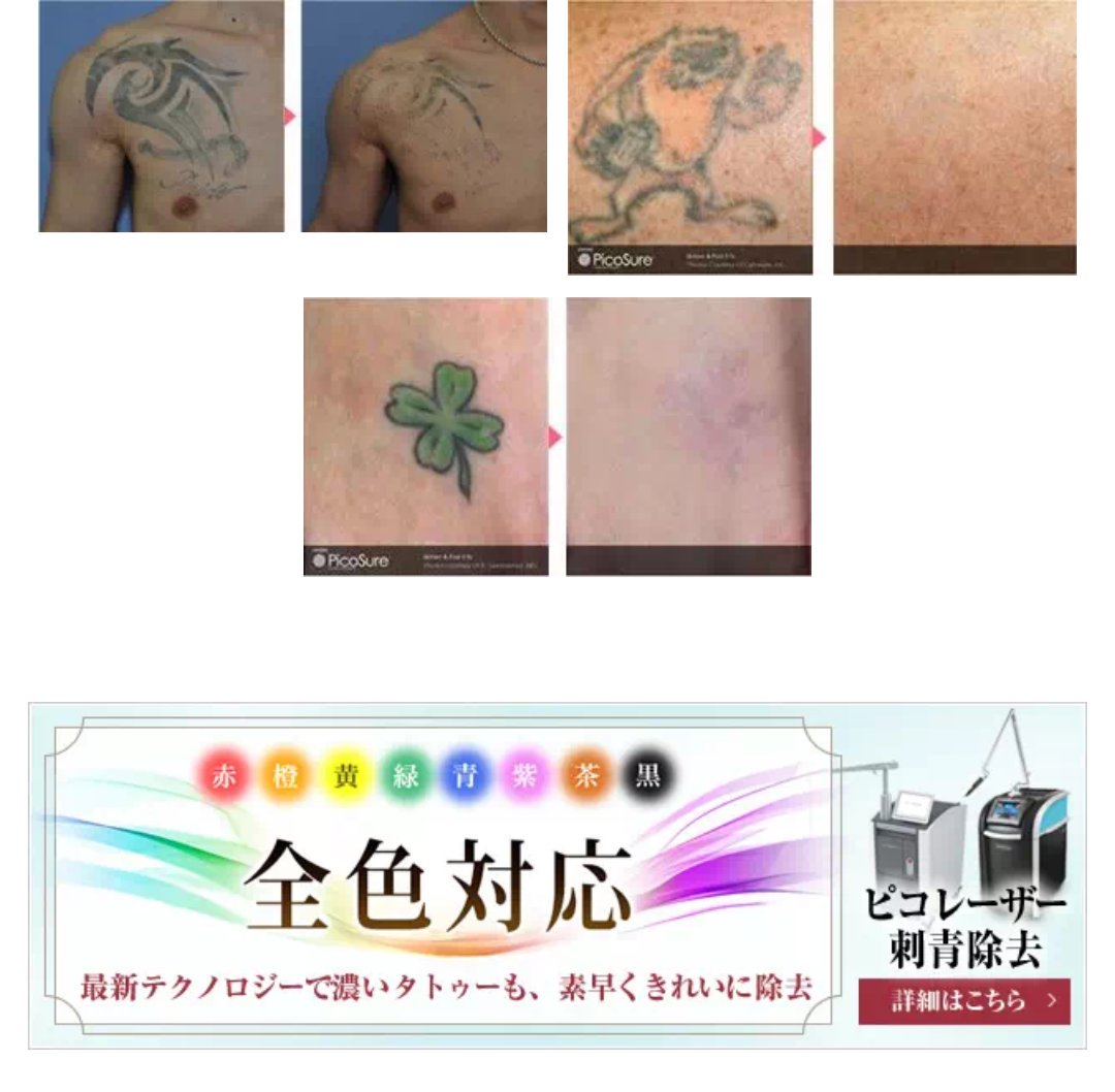 刺青除去 刺青除去