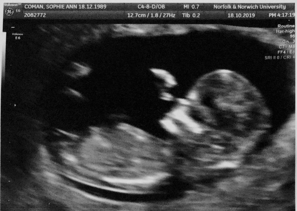 Little_Soph's tweet photo. Seems apt to post this on here too, seeing as twitter brought us together @lacesoutdan ππ. This little guy (size of a lime currently) due in April!π₯° #adultingtime #babycoman #herecomethecomans π https://t.co/zNcDlPNF78