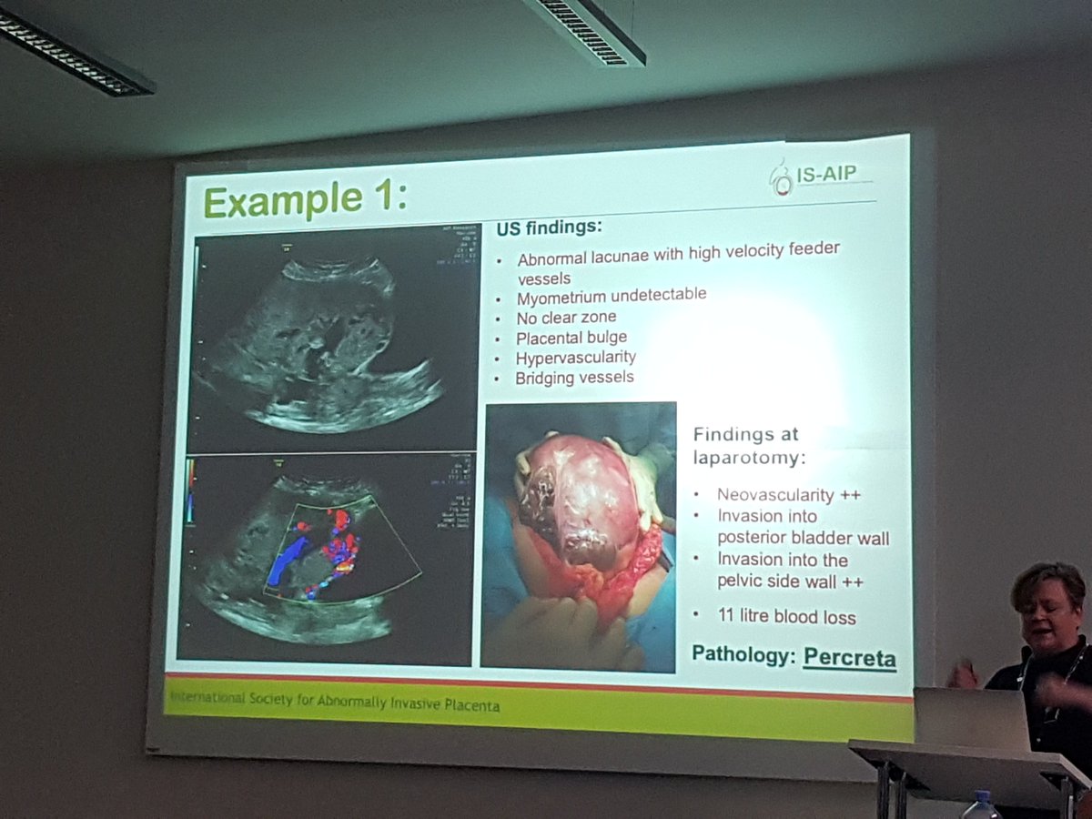 GorsekTinc's tweet photo. Attended the IS-AIP meeting yesterday. As a basic researcher it was very  important for me to see how obstetricians deal with #abnormallyinvasiveplacenta. #heros #IS-AIP @AccretaResearch @dp_idp #placentaresearch #placentalab #phdlife #placentaaccreta https://t.co/NMYeJ6AKZx
