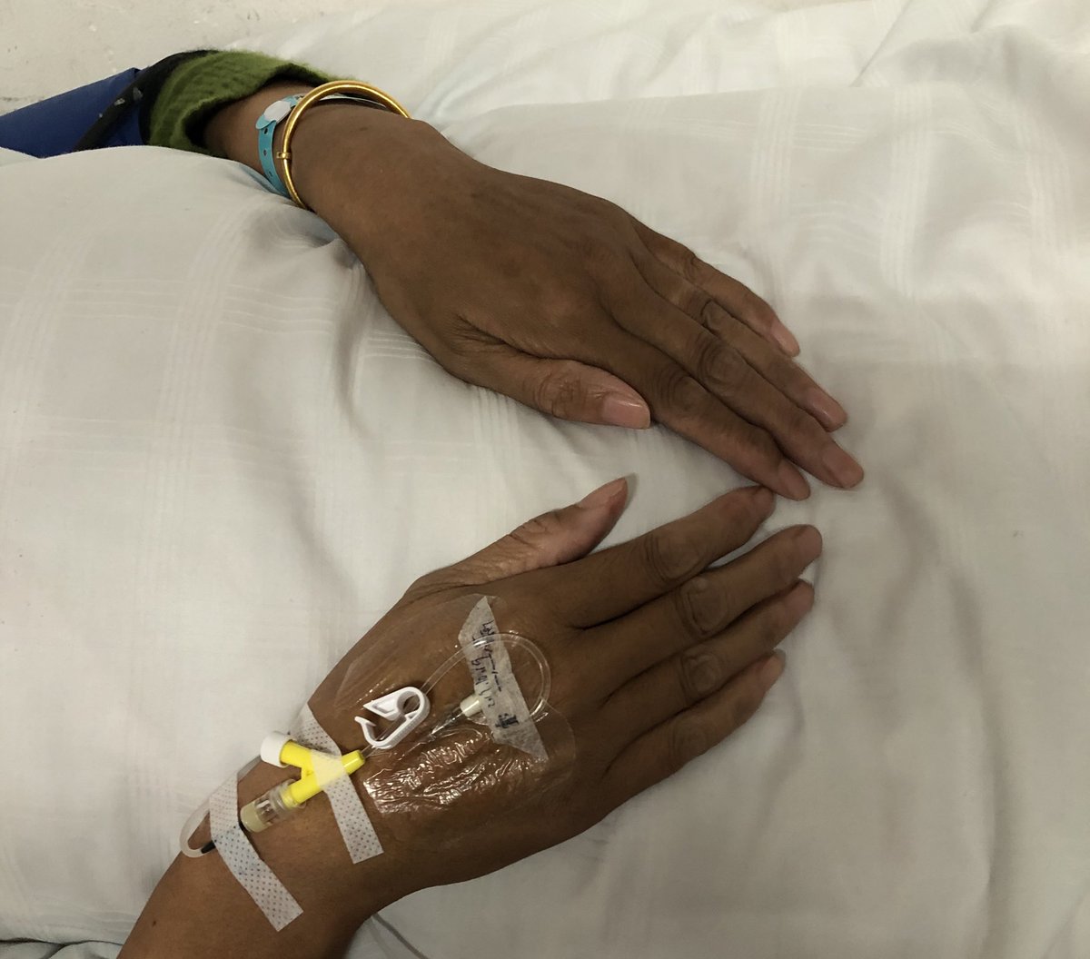 今天碰到了一个马凡氏综合征的患者，胸痛主诉就诊，身材瘦高，四肢细长、蜘蛛指，双手下垂过膝，家族性猝死史，因为实在太典型就想先做主动脉CTA，不巧增强CT机器坏了，结果心脏彩超和颈股动脉彩超直接报了主动脉夹层（Stanford-A型），范围从主动脉根部至右颈总动脉