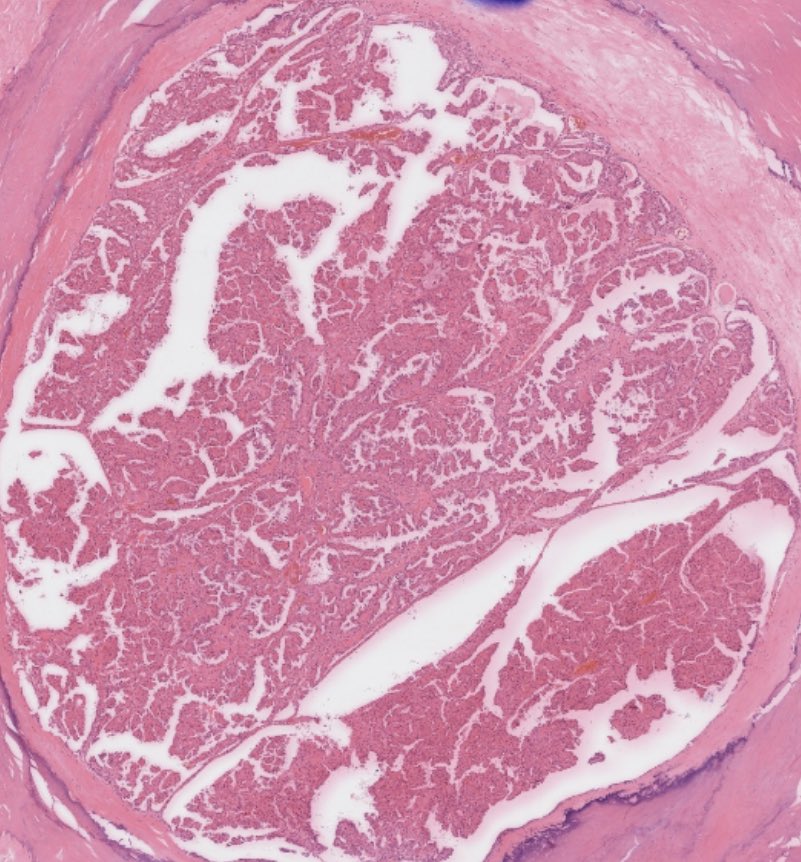 pathkids's tweet photo. EPON (encapsulated papillary oncocytic neoplasm). A rare morphological mimic of papillary carcinoma but has cytology and behaviour of Hürtle cell adenoma. https://t.co/CayzA3iVmB