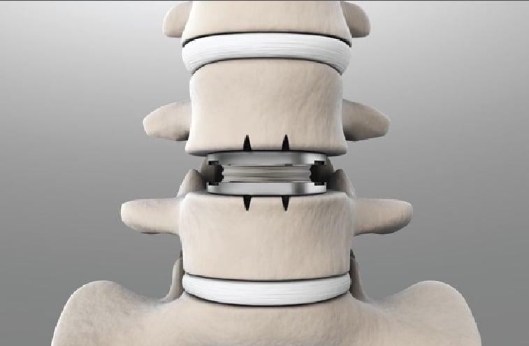 DrSusmitNaskar's tweet photo. ✔️ Artificial #Spine #LumbarDisc Replacement in India
▫️
▫️
✔️ Are you suffering from spinal or any other related pain? Request an appointment with Dr. #SusmitNaskar today. Visit https://t.co/bH9ibCy8q5 for appointment.
▫️
▫️
✔️ #SpineLumbarDisc https://t.co/5BL3vnJCAJ