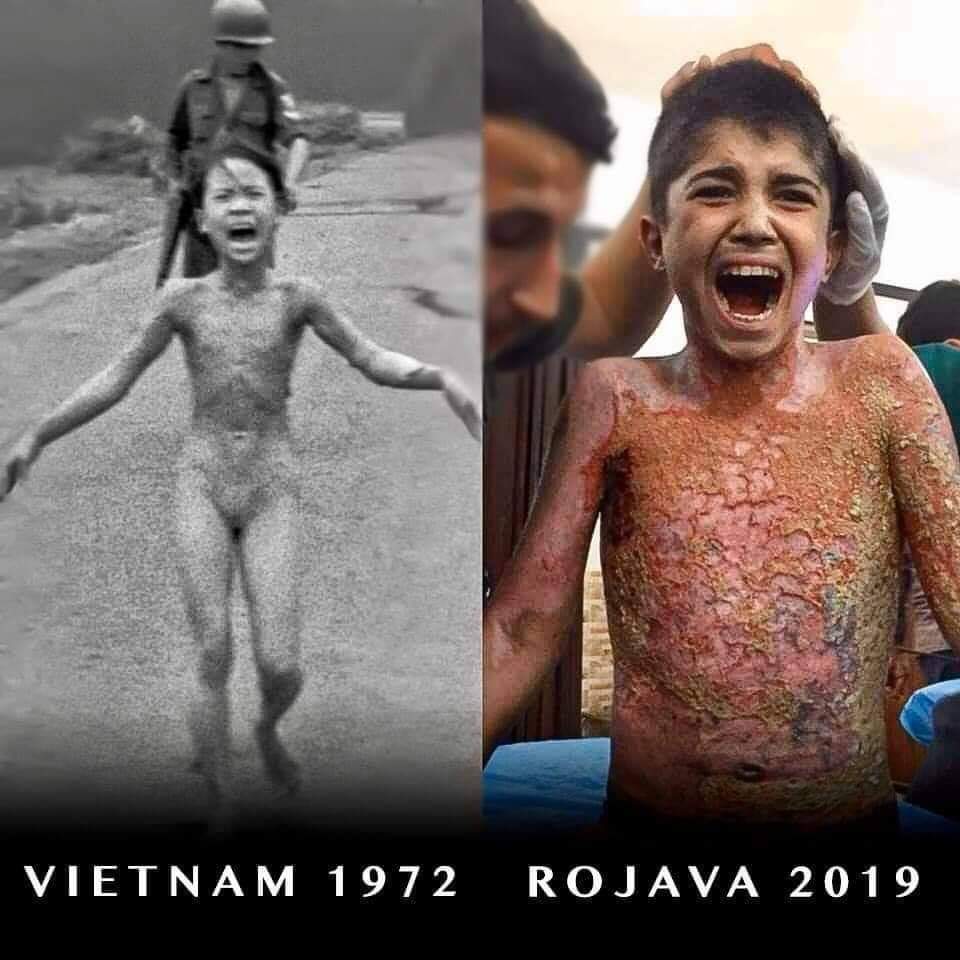 RojanPshdary's tweet photo. Childern of war! 

#Phosphour_of_Turkey_Kills_Our_people
#فوسفور_تركيا_يقتل_شعبنا
#چەکی_فسفۆری_تورکیا_گەلەکەمان_دەکوژێ

#rojava #SaveRojava  #kurdistan #kurd #kurds #TurkeyIsATerrorState #TerroristTurkey #bannedwepons #TurkeyIsATerrorState
#fascistTurkey https://t.co/cFKvbz4T0N
