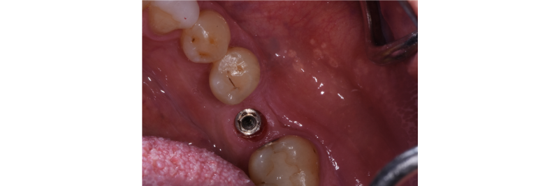 greggkinzerdds's tweet photo. A Technique for Evaluating the Continuity of Implant Hex Connections:                              https://t.co/EP3hjLVVCs https://t.co/vgstjJomfy