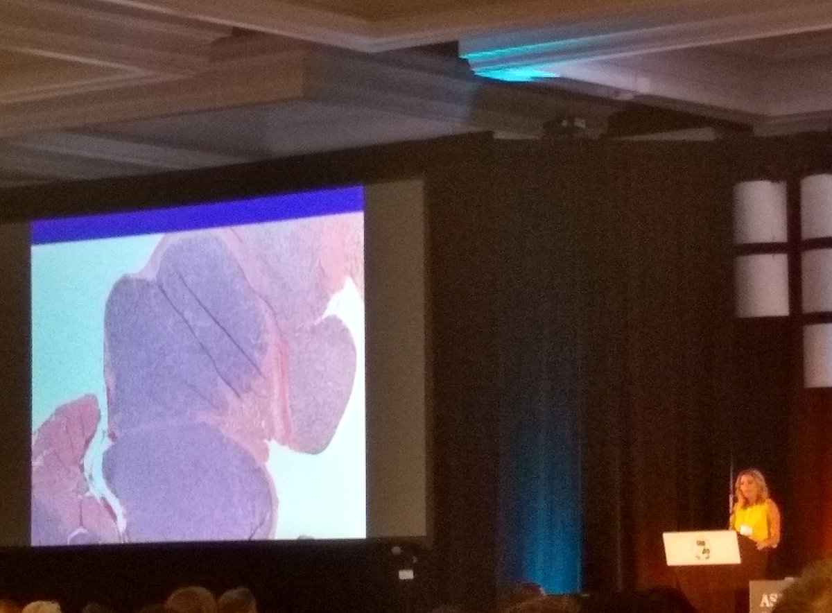 FrozenSections's tweet photo. Dr. Jennifer Ko presenting evening slide symposium cases. CRTC1-TRIM11 fusion melanocytic tumor  @JenniferKo79 
#ASDP19 #ASDPTweets @CLEClinicLabs @ClevelandClinic @CleClinicNews https://t.co/xL5ThmGgbK