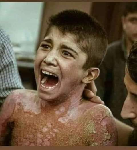 Zeredest1's tweet photo. Child Mohammed al-Kurdi burn white phosphorus for weapons banned internationally by the Turkish army Mohammadi terrorist and his aides from the Syrian military terrorist factions Where is the free world Where is humanity from this crime and terrorism? https://t.co/O0lcz2hKRZ