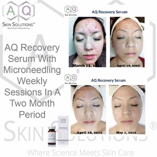 I can't imagine how life changing this must be. This transformation took only 2 months. The amazing Growth Factor Induced Therapy (GFIT). Available now at VB Aesthetics. Call 07843437388 for info
#growthfactors #GFIT #aqskinsolutionsuk @bridieskinuk #acne #oilyskin #acnescars