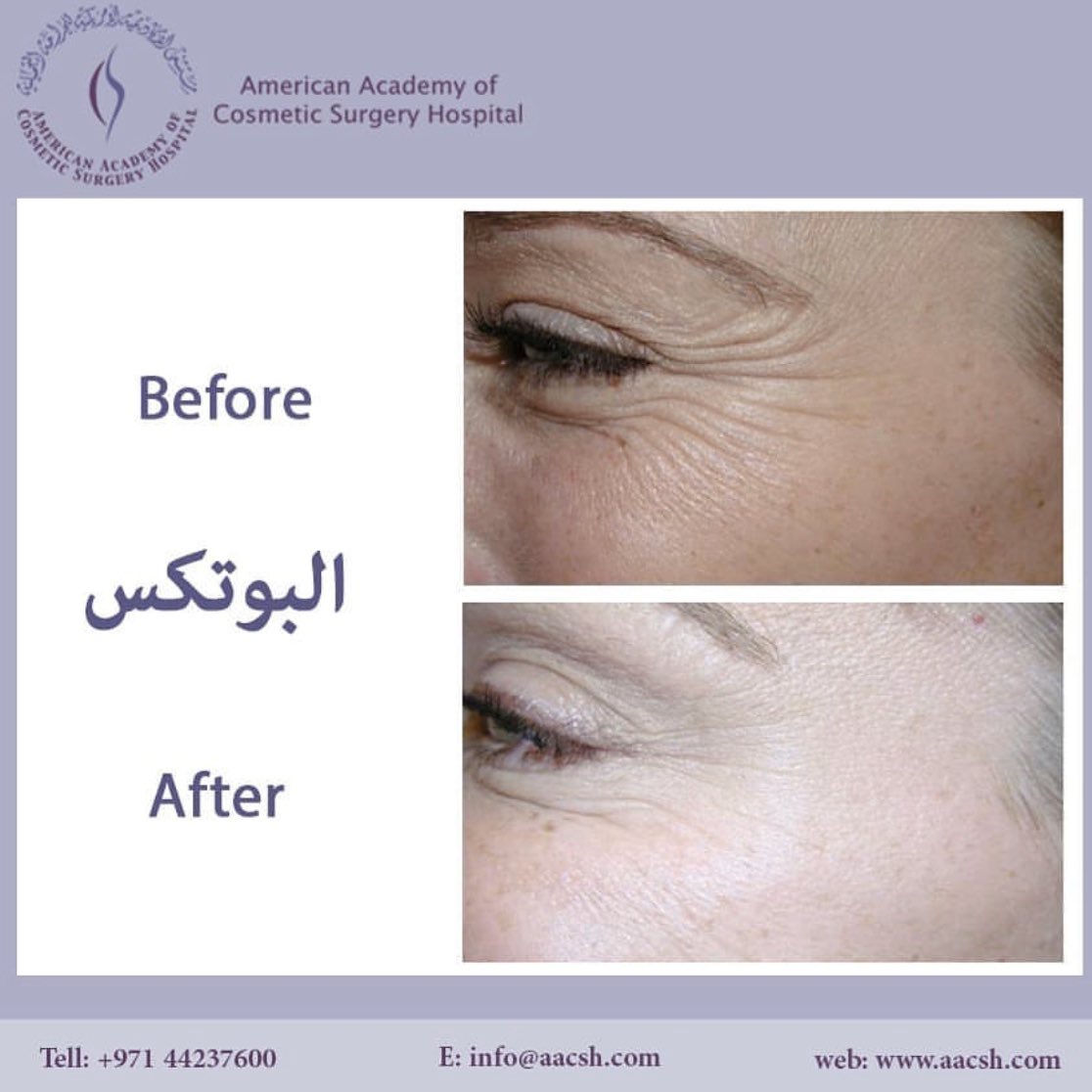 aacsh_botox's tweet photo. نعرض في هذه الصورة نتائج حقن #البوتكس https://t.co/YZLpQZQQTI