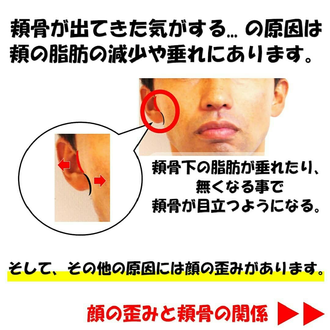 顔顎矯正 鍼灸接骨院 リビジョン 続き 大人の頬骨が更に横に成長する事はありません 出っ張りの原因は 頬の脂肪や皮膚の弾力性の低下と顔の歪みです 輪郭を丸くしている弾性繊維が変性すると脂肪が下がり 丸みがなくなって頬骨だけが目立ちます