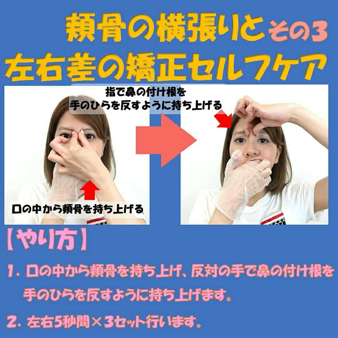 顔顎矯正 鍼灸接骨院 リビジョン 続き 大人の頬骨が更に横に成長する事はありません 出っ張りの原因は 頬の脂肪や皮膚の弾力性の低下と顔の歪みです 輪郭を丸くしている弾性繊維が変性すると脂肪が下がり 丸みがなくなって頬骨だけが目立ちます