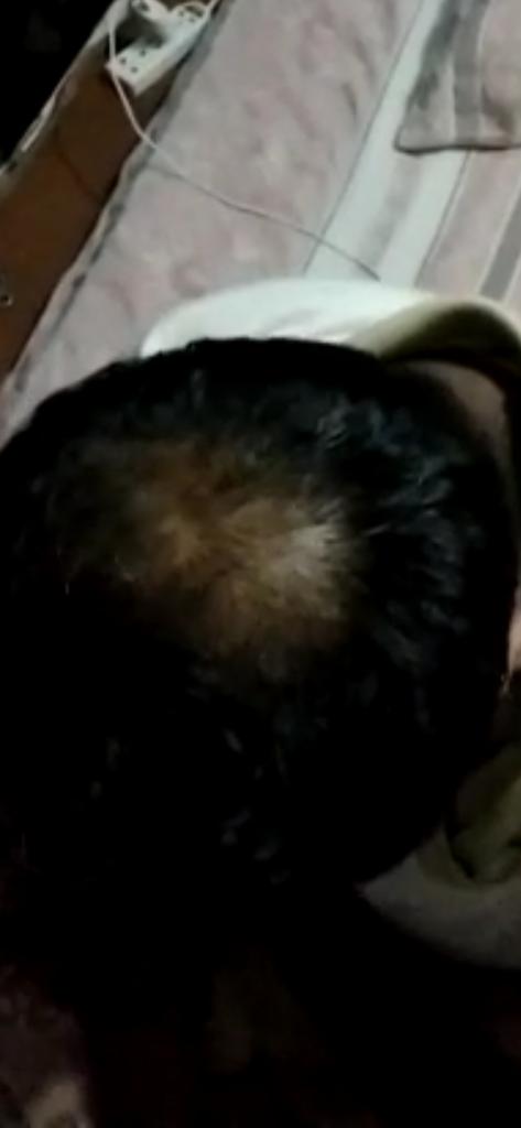 Dr_Abdul_Malik's tweet photo. Be attentive to check out the #DrAbdulMalik #patient, Dr. Taimoor before and after #PRP #Treatment, excellent result of #HairFall stop , increased #Growth of existing #Hair#CosmeticSurgeon, #Surgeon #DrAbdulMalik #PRP #PRPTherapy, #PRPTreatment, #PRPHairLossTreatment, #prpforface https://t.co/wN6ltGLDIF